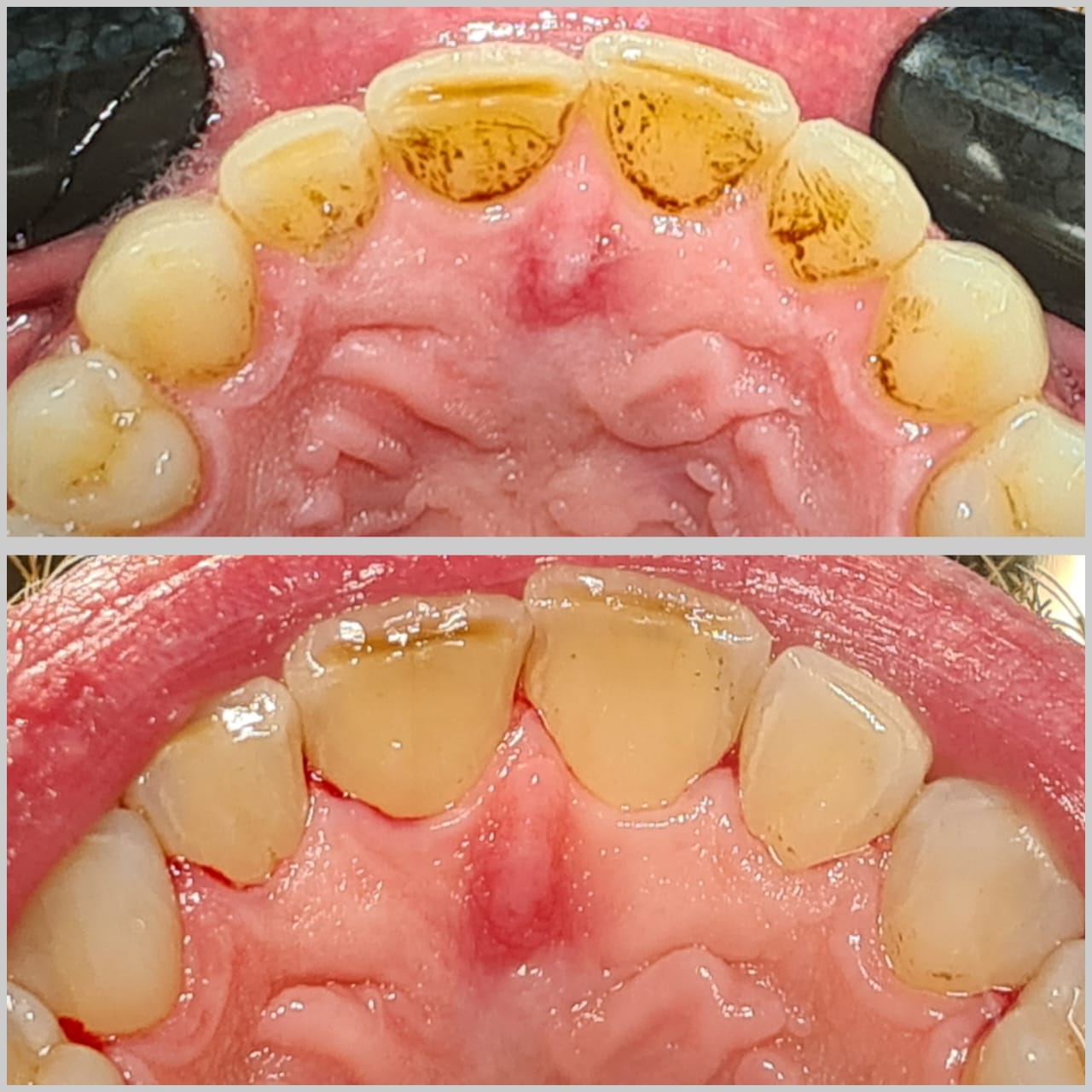 Consulta preventiva (profilaxia e raspagem)