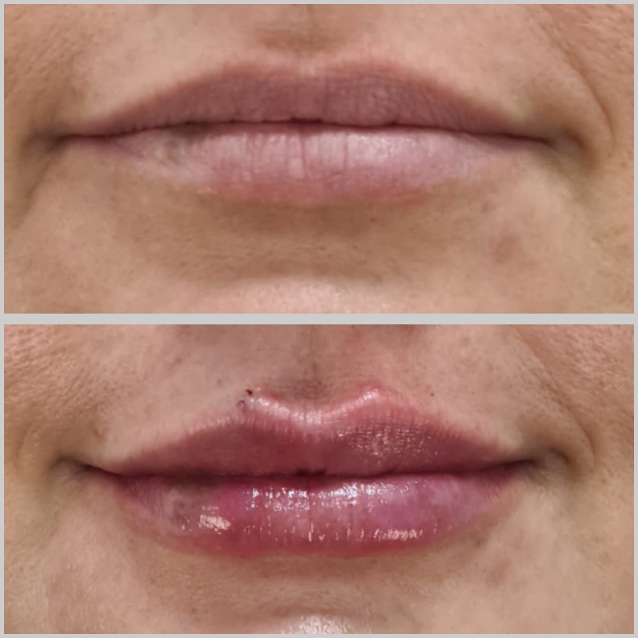 Preenchimento-labial